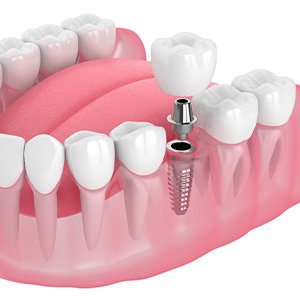 Illustration of a single dental implant