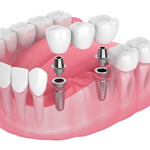 Illustration of an implant bridge