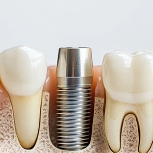 Dental implant surgery is where your dentist places your dental implants in your jaw