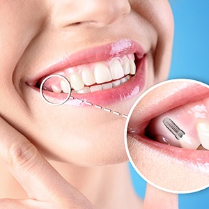 Osseointegration happens when your dental implant fuses with your jawbone