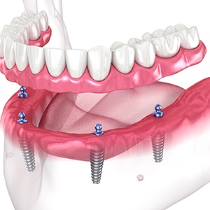 The final step is the delivery of your prosthetics including implant dentures, crowns, or dental bridges