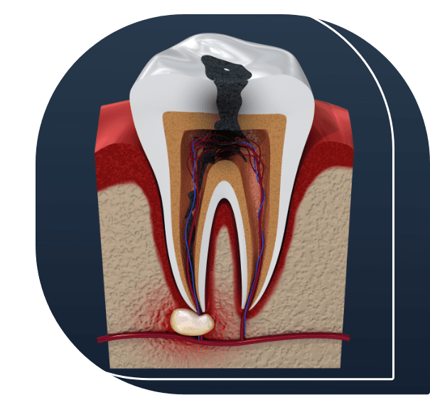 Illustration of a decayed tooth needing pulp treatment