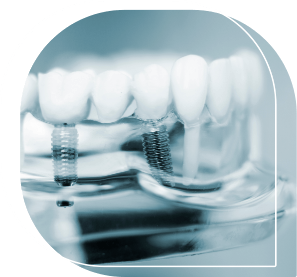 Model of the mouth with two dental implants replacing teeth