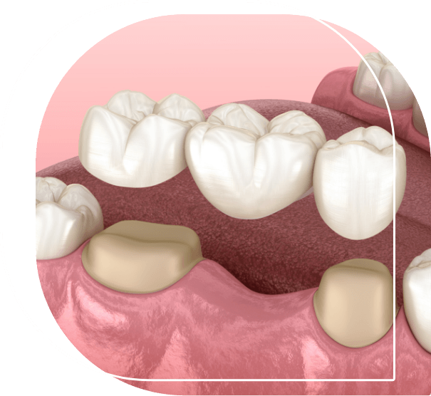 Illustrated dental bridge being placed to replace a missing tooth