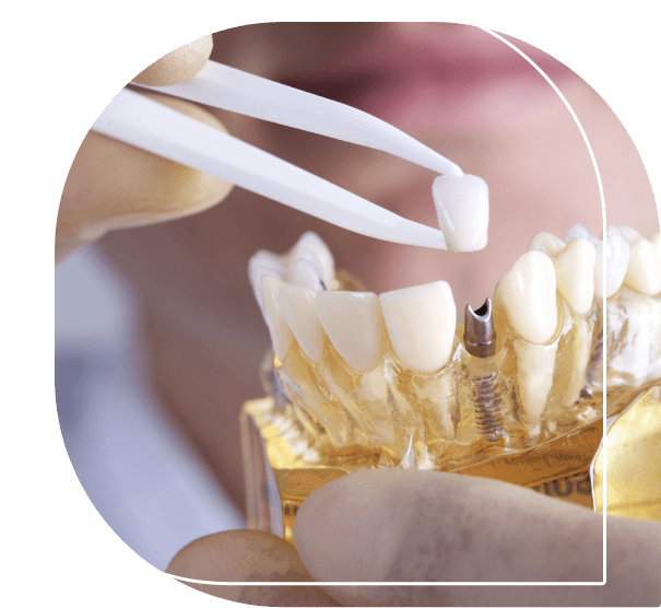 Dentist holding a model of the mouth with a dental implant replacing one tooth