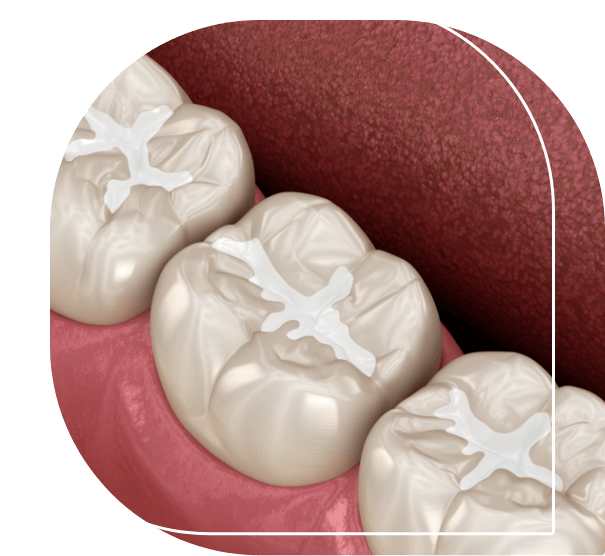 Illustrated row of teeth with white fillings