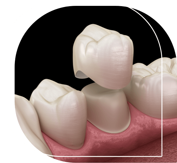 Illustration of a dental crown being fitted over a tooth