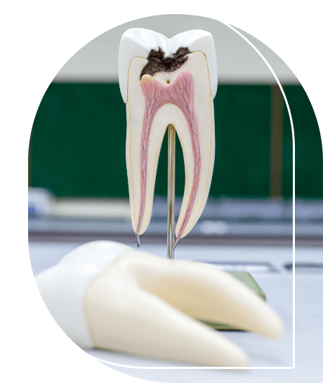 Model of a decayed tooth that needs root canal treatment