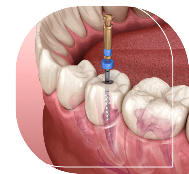 Illustration of a dental instrument treating the inner layer of a tooth