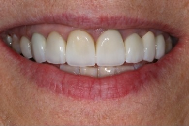 Close up of mouth with better aligned teeth after dental treatment