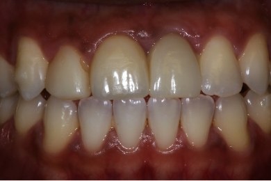 Mouth after straightening and restoring teeth