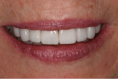 Mouth after teeth have been whitened