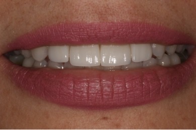 Mouth with much whiter teeth