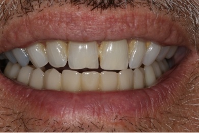 Mouth after treating tooth stains and gum recession