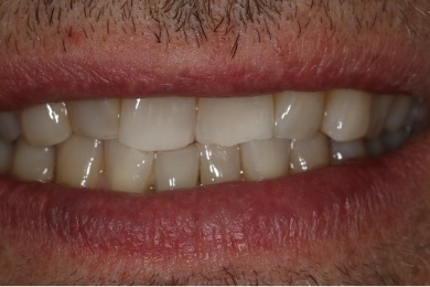 Mouth after correcting discolored teeth