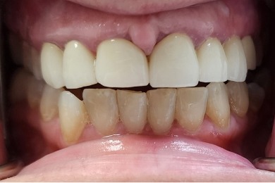 Close up of mouth with uneven teeth before dental treatment