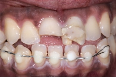 Mouth with several broken and crooked teeth