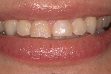 Mouth with slightly yellowed teeth