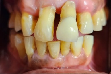 Mouth with severely damaged and yellowed teeth with receding gums