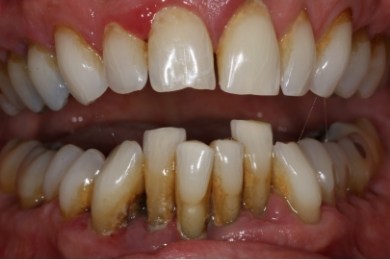 Mouth with severely stained teeth and receding gums