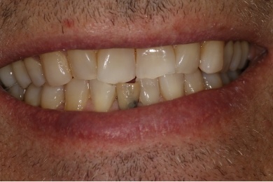 Mouth with discolored teeth