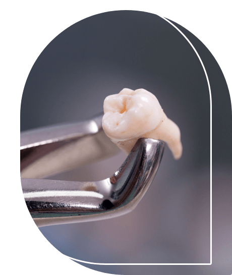 Dental clasps holding an extracted tooth